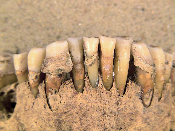 Zahnstein an den Zähnen eines Unterkieferfragmentes aus Wulsdorf im Kreis Bremerhaven